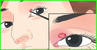 See full list on mayoclinic.org 26 Effective Home Remedies To Get Rid Of Eye Stye
