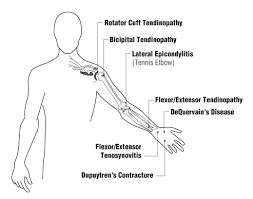 It causes pain in the backside of the elbow and forearm, along the thumb side when the arm is . Tendon Disorders Osh Answers