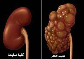 كيف يتم علاج الكلي المتكيسة بدون جراحة شفاء