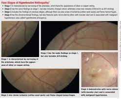 How Hypertension And High Cholesterol Harm The Eye