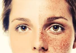 Freckles Removal