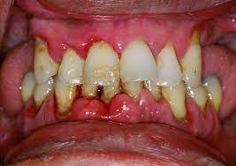 Periodontal Gum Disease Institute Of Dental Implants Periodontics