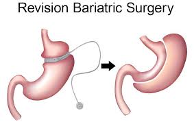 Gastric sleeve reduces the size of your stomach. Revisional Bariatric Surgery Dallas Tx Types Insurance Cost Results