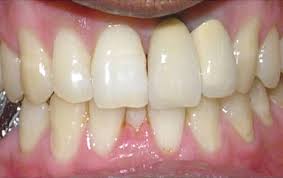 Maybe you would like to learn more about one of these? Dental Filling And Tooth Cavity Filling Cost Treatment Causes