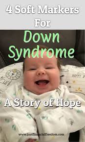 4 Soft Markers For Down Syndrome A Story Of Hope Down Syndrome Down Syndrome Baby Down Syndrome Ultrasound