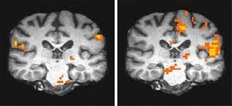 Brain Scans Depict Gulf War Syndrome Damage Brain Scan Brain Images Syndrome