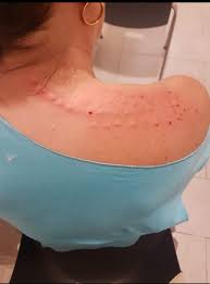 Cervicalgia con rigidità al collo -