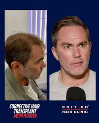 CORRECTIVE HAIR TRANSPLANT ✓ @trigs4