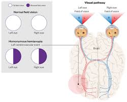 Stroke Classification And Diagnosis Cpd Article