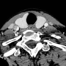 The tear may cause stenosis, an irregular narrowing of the opening in the vessel, and occlusion, a flap of the vessel wall protruding into the opening. Arterial Dissection Into Common Carotid Artery Radiology Case Radiopaedia Org
