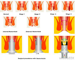 • hemorrhoids • surgery • radiation • chemotherapy. How Do I Use A Sitz Bath For Hemorrhoids With Pictures