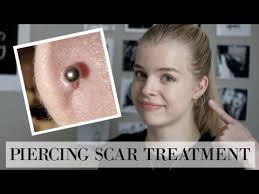 Is it possible to remove my nose piercing marks? How To Treat Hypertrophic Scars Piercing Bumps Youtube
