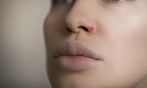 Herpes Nicht Nur An Den Lippen Ein Problem