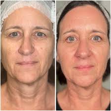 Alyssa Brewster LE, CLO/A| Fort Collins Waxing & Skincare  (@baredowntherefoco) · Fort Collins, CO