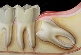 Maksiller Sinus Nedir Ve Nasil Acilir Dentram