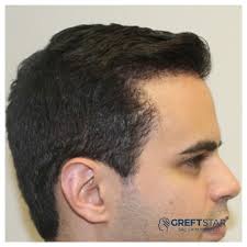 Greft Star Adli Kullanicinin Sac Ekimi Samsun Panosundaki Pin Sac Galeri