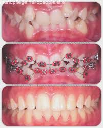 Transformation Braces Braces Dental Braces Teeth Braces Braces Transformation