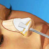 We did not find results for: Virtual Nose Job Surgery Play Virtual Nose Job Surgery Online On Silvergames