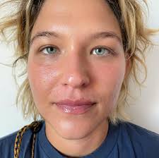 FUNGAL ACNE. It's a misnomer as fungal “acne” technically isn't acne, but a  fungal/yeast overgrowth that PRESENTS as acne. Recently I've had an influx,  4 clients, in the past month with fungal