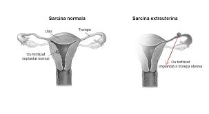 Sarcina extrauterină este o condiţie foarte periculoasă şi o cauză majoră de deces a femeilor gravide, în primul trimestru al sarcinii. Sarcina Extrauterina Simptome Cauze Si Tratament Viata Sanatoasa