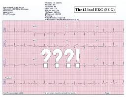 Eheart Introduction To Ecg Ekg