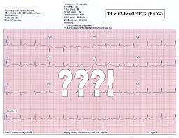 Eheart Introduction To Ecg Ekg