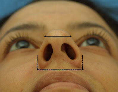 Alar Base Modification - Rhinoplasty Archive