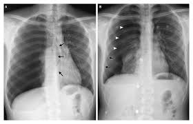 Image result for Open Pneumothorax