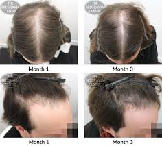 Of course, hair re growth is possible. Hair Growth Success Significant Progress Has Been Made