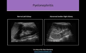 Infection Of The Kidneys Perinephric Fluid Collections Diagnostic Medical Sonography Ultrasound Sonography Sonography