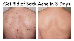 Back acne (bacne) scars are left over scars, caused due to the deep and severe breakouts of back acne in the form of pimples and blackheads. How To Get Rid Of Back Acne At Home In 3 Days Youtube