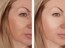 Fillers For Under Eye Wrinkles Before and After Results