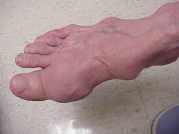 I will probably go back to the podiatrist again. Gout Risk Factors Diagnosis And Treatment
