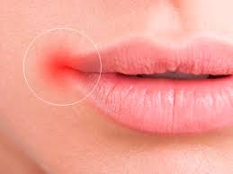 Check spelling or type a new query. Cual Es El Mejor Tratamiento Para Las Boqueras