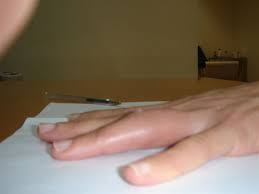 Entorse De L Articulation Interphalangienne Proximale Des Doigts Chirurgie De La Mainchirurgie De La Main