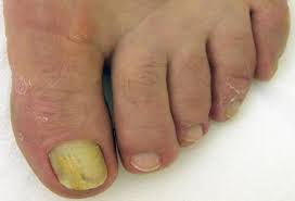 Image result for Beau lines feet