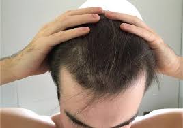 حتي لا يتم خداعك تعرف علي تفاصيل تكلفة زراعة الشعر في تركيا بالريال السعودي زراعة شعر زراعة الشعر زراعة الذقن زراعة ا Behind Ear Tattoo Ear Tattoo Ear