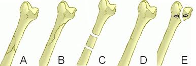 Image result for Fracture Types
