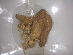 File:Human feces containing barium sulfate suspension.jpg - Wikipedia