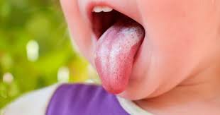 Baking soda may also help kill the yeast that causes the fungal infection and maintain healthy ph levels in one popular yeast infection remedy is an apple cider vinegar bath. Thursh In Babies Causes Symptoms And Treatment