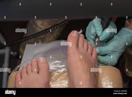 Image result for Onycholysis feet