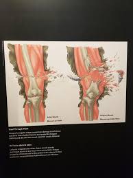 The story goes that a.50 cal. Difference Between A Bullet Wound And A Shrapnel Wound Mildlyinteresting