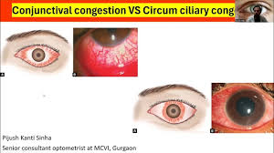 Image result for Ciliary Flush