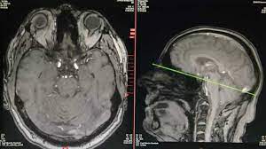 Verschieden aussehend bedeutet, dass die gewebe in unterschiedlichen graustufen zu sehen sind. Edel Im Schadel Mrt Von Meinem Kopf Magnetresonanztomographie Youtube