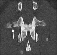 It typically occurs from abrupt extreme twisted or side bending movement. Typically Stable Subsection 3a Clinical Imaging Of Spinal Trauma