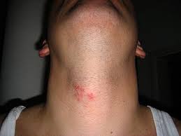 Herpes Zoster Wikiwand