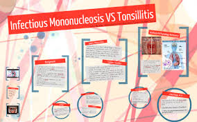 Mononucleosis, or mono, has a wide range of symptoms that can make it hard to diagnose. Infectious Mononucleosis Vs Tonsillitis By Heather Troupe