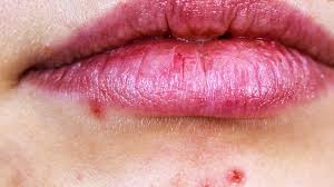 It is caused by the herpes simplex virus 1, and is referred to as oral herpes. Spot On Lip Causes Symptoms And Treatment