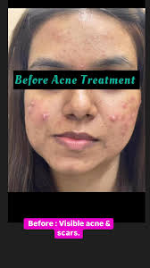 Struggling with hormonal acne and scars? 🌟 At Parisa Skin Clinic, we  create customized treatment plans tailored to your unique skin needs. Watch  how we transformed this patient’s skin despite ...