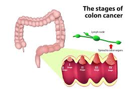 Higher numbers mean the cancer is more advanced. Cancer Staging Ausmed